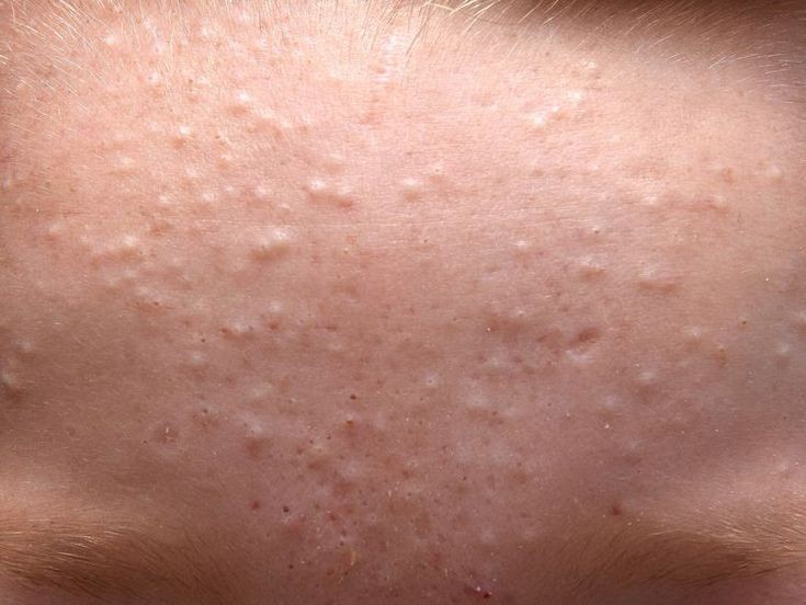 pelle grassa asfittica