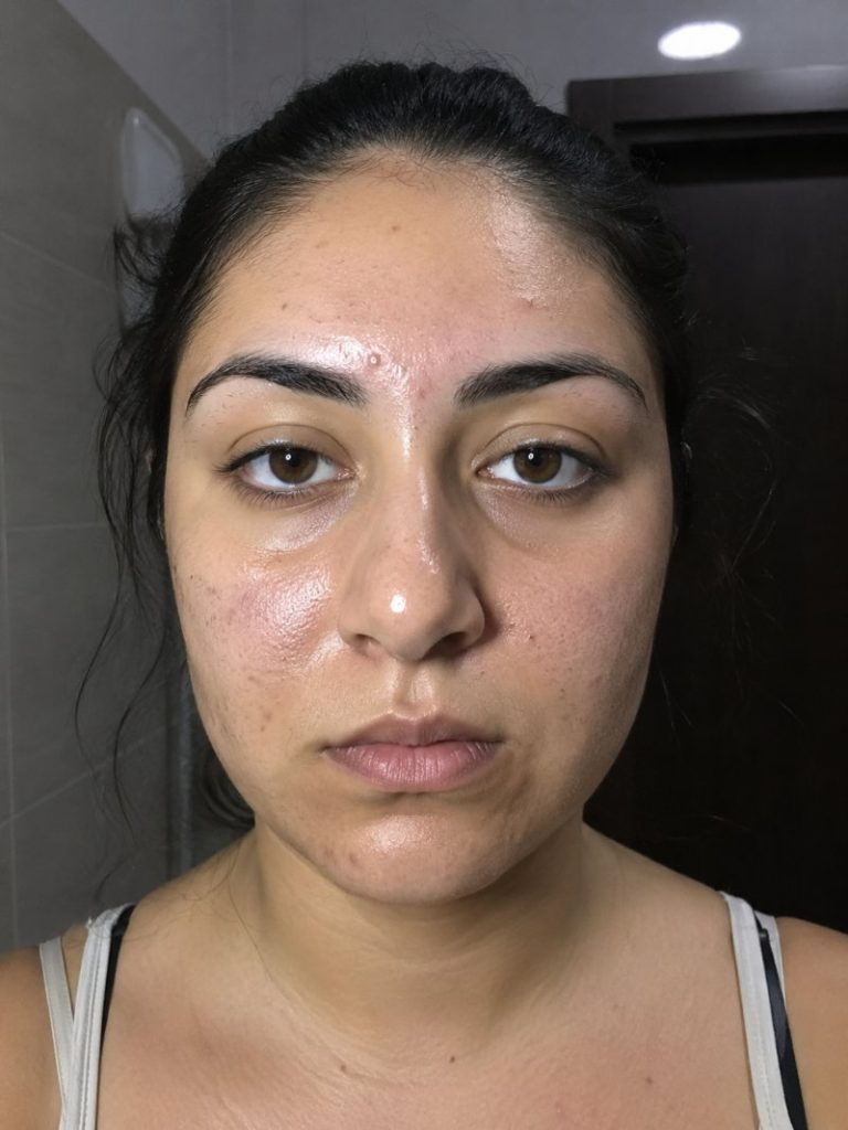 ragazza con tipo di pelle grassa